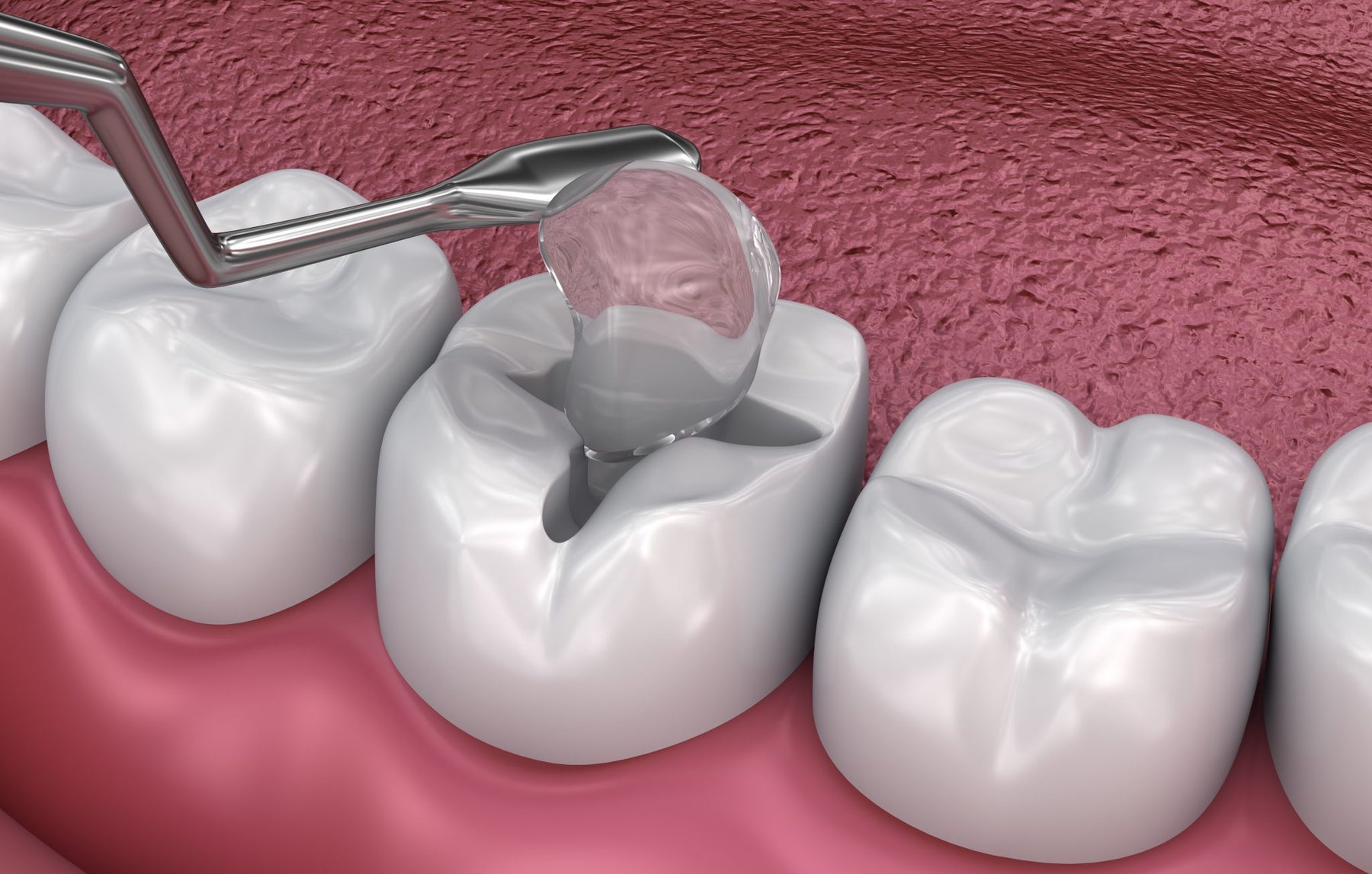 Composite Sculpting: Tools for Esthetic Dental Procedures