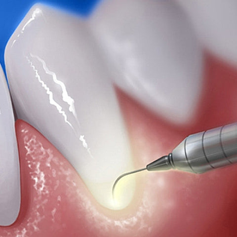 Periodontal Tools: Enhancing Gum Health
